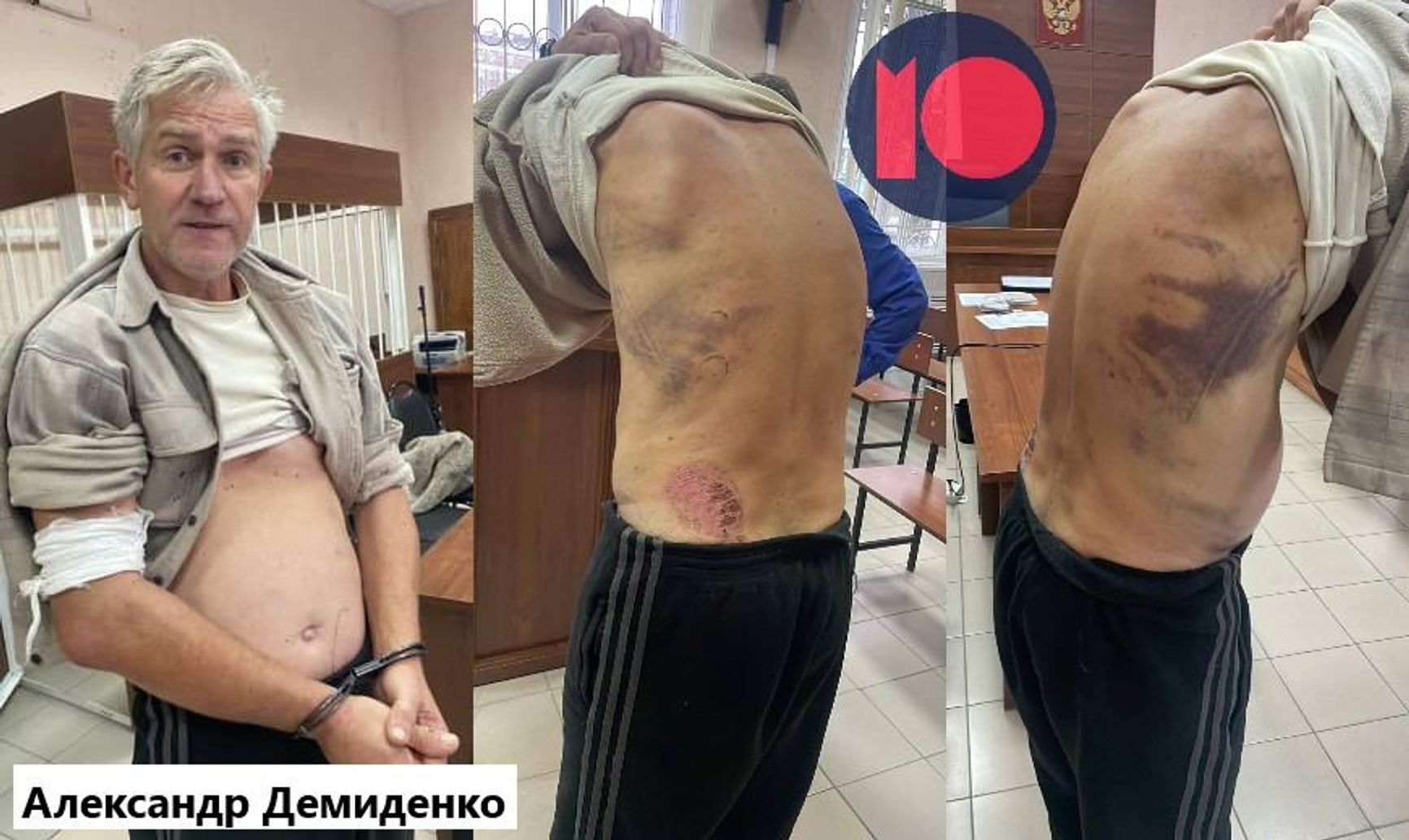 Следы избиений на теле Александра Демиденко 