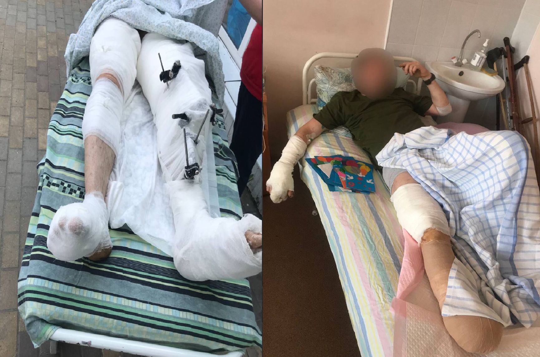 A military serviceman whose limbs were saved by doctors, and a serviceman with an amputated foot
